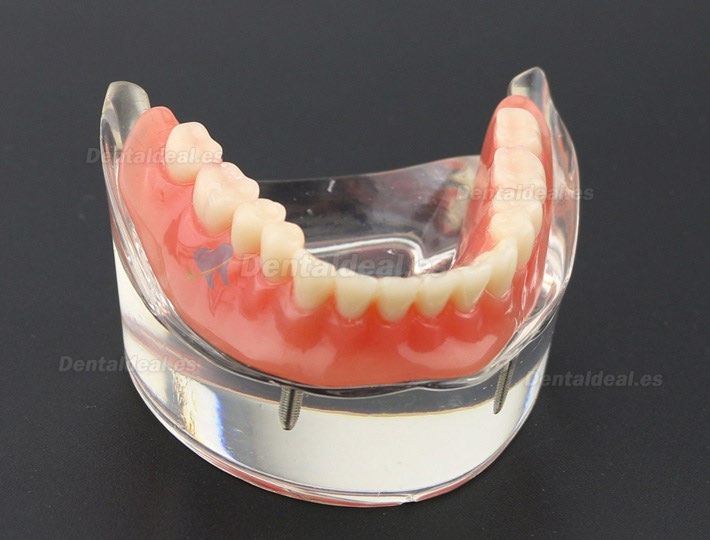 Dental Dientes inferiores Modelo de sobredentadura 2 Implantes Demostración Modelo 6002 01